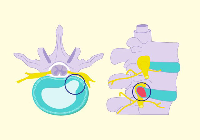 治腰间盘突出小技巧
