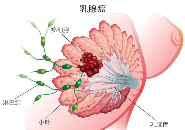 新的高度个性化免疫疗法可有效治疗晚期乳腺癌