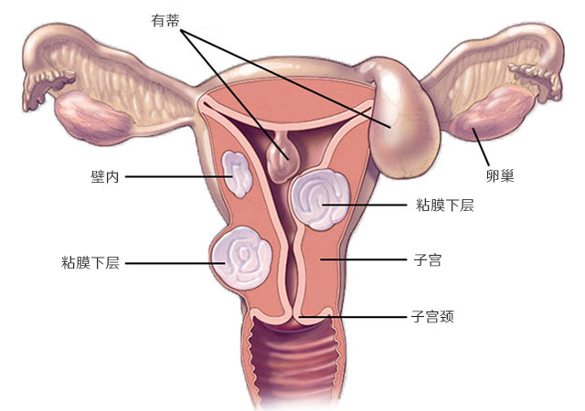 子宫平滑肌肉瘤是什么原因引起的及体征症状治疗方法