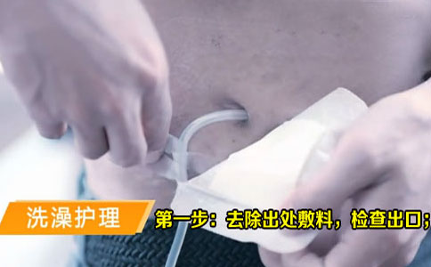 腹膜透析患者洗澡时该注意那些问题