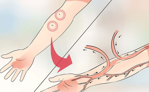 尿毒症在手臂做瘘感觉血流突突的，刀口附近胀痛