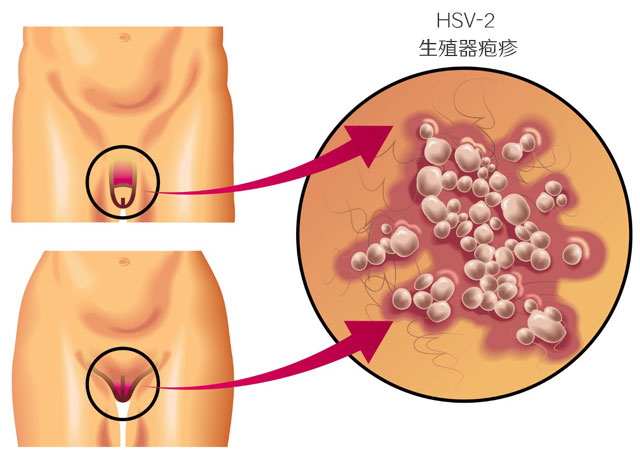 HSV-2生殖器疱疹的长期危害