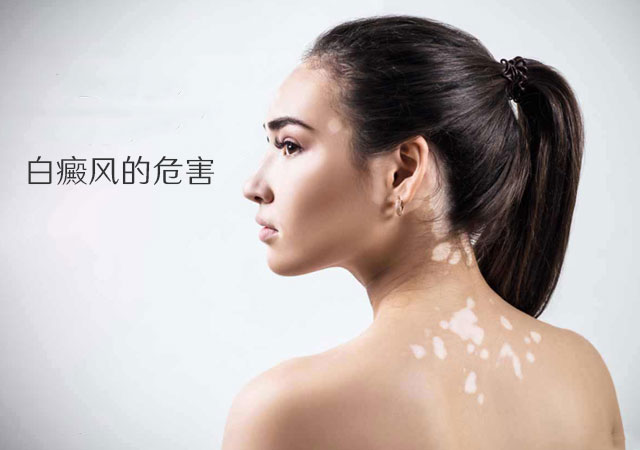 白癜风的危害