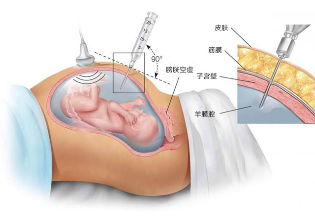 白化病怀孕产检能查出来