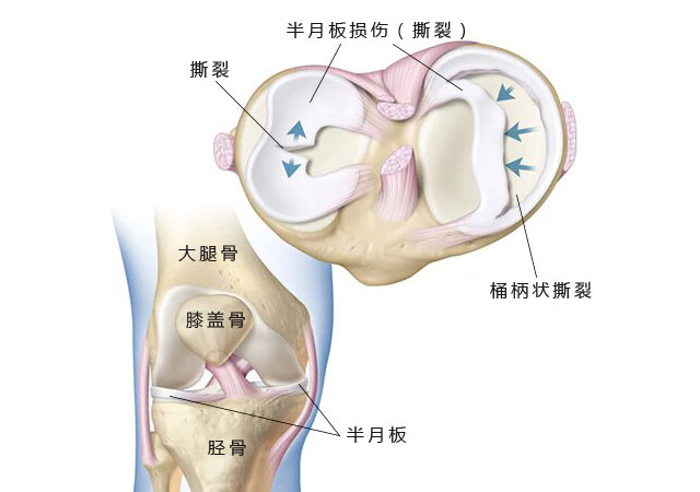 半月板损伤（撕裂）图片