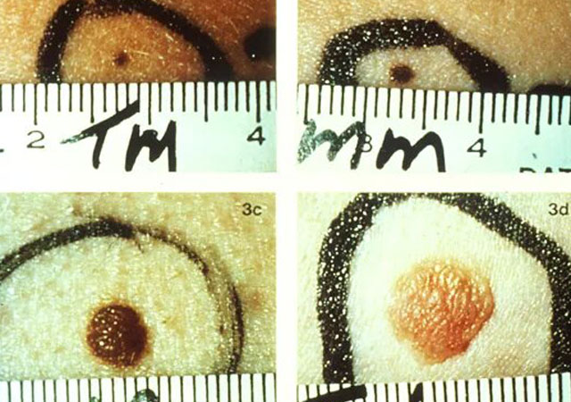 不同大小和颜色的痣