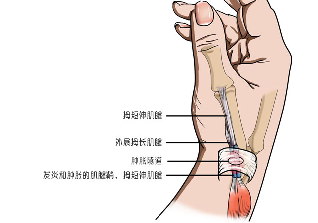 大拇指腱鞘炎