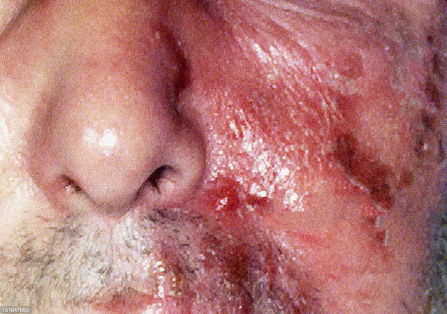 丹毒面部图片，其特征肿胀，发红，硬化