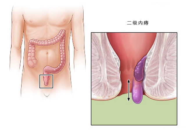二级中度内痔疮图片