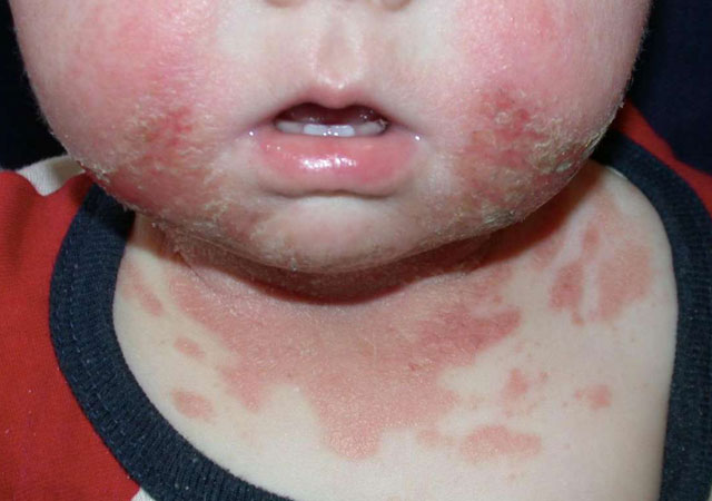 儿童皮肤过敏症状：过敏性接触性皮炎的样子图