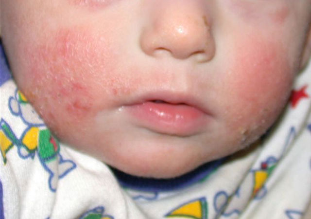 儿童皮肤过敏症状：湿疹的样子图