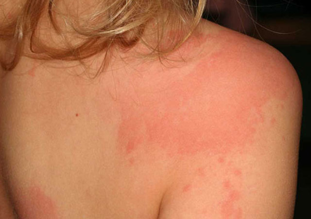 儿童皮肤过敏症状：荨麻疹的样子图