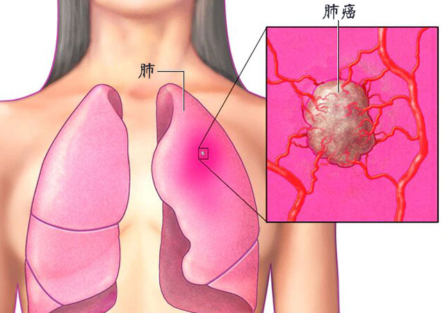 9大肺癌早期症状表现前兆有哪些