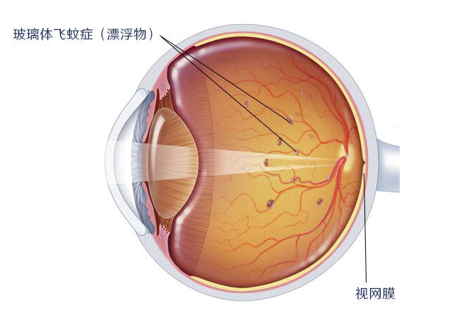 飞蚊症最好的治疗方法激光治疗