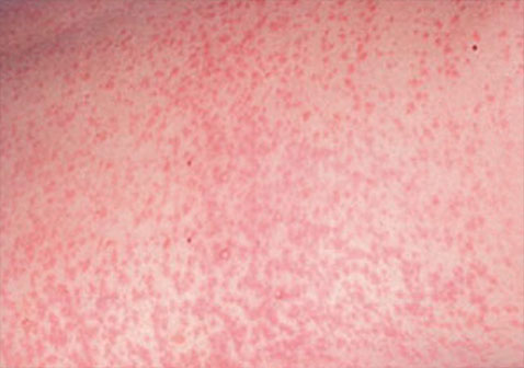 风疹图片和症状图片红色丘疹