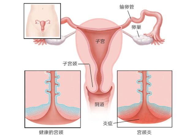 宫颈炎示意图