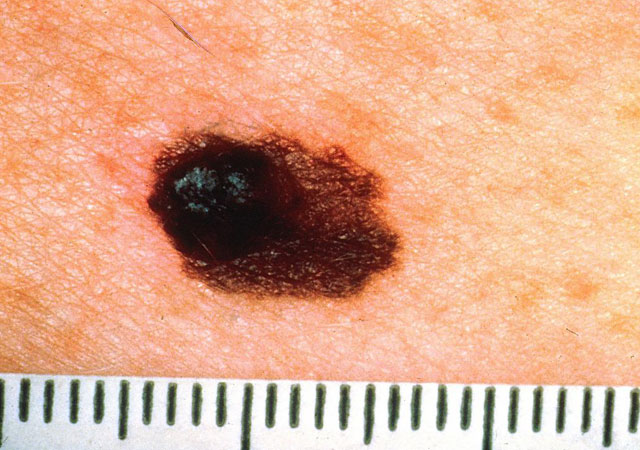 黑色素瘤用测量尺来显示大小