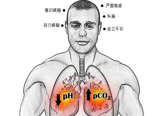 呼吸性酸中毒症状图示