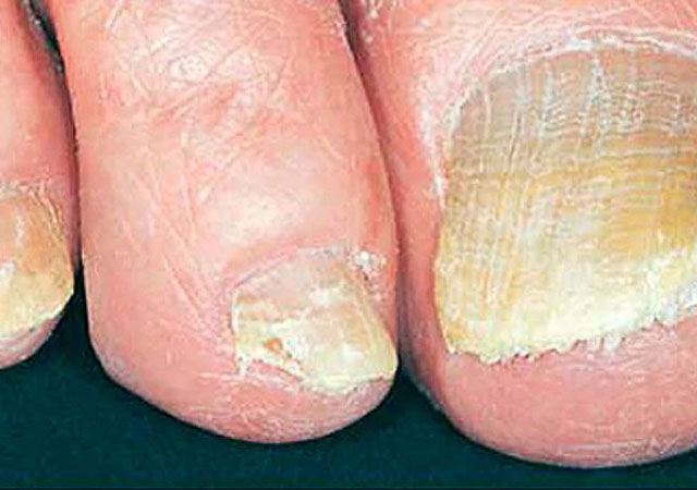 灰指甲会使指甲变粗或粗糙，呈黄色，绿色，棕色或黑色