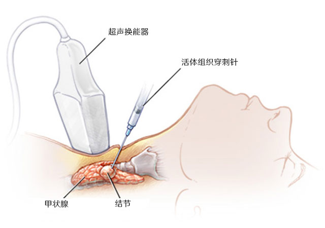 甲状腺穿刺示意图