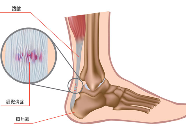 脚跟腱鞘炎