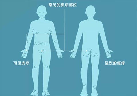 疥疮的症状与部位