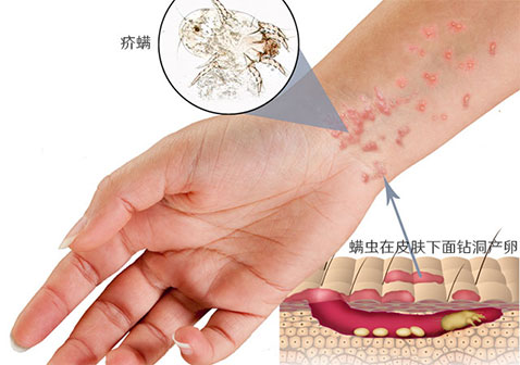 疥疮是什么样子疥虫感染初期小红点和爬过的痕迹症状图片