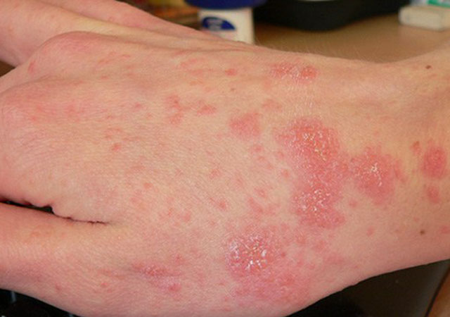 小的，凸起的红色斑点和持续的瘙痒通常表明疥疮感染