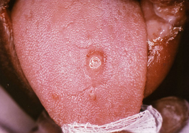 梅毒1期舌头症状图片