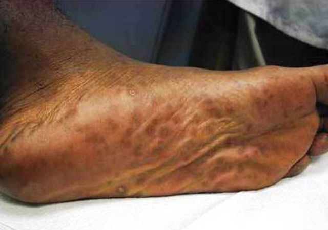 梅毒2期脚底皮疹症状图片