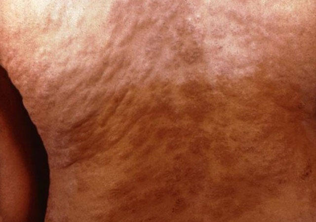 梅毒2期躯干背部皮疹症状图片