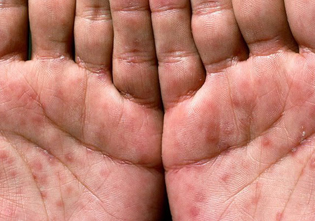 梅毒2期手掌皮疹症状图片