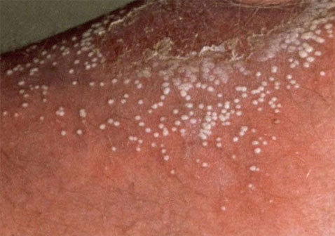 脓疱型银屑病。注意皮肤上明显隆起的肿块，充满脓疱。肿块下面和周围的皮肤是红色的