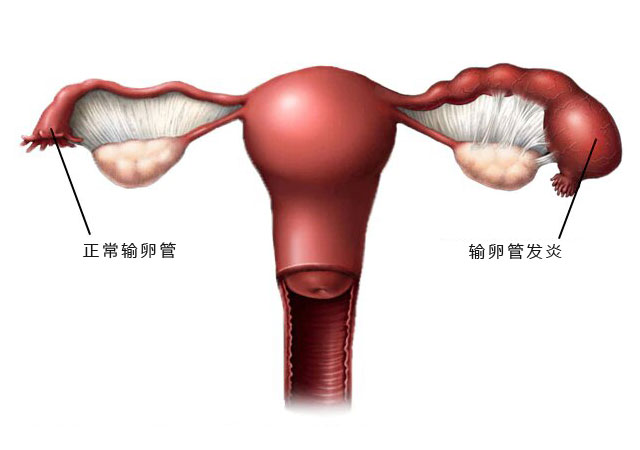 盆腔炎