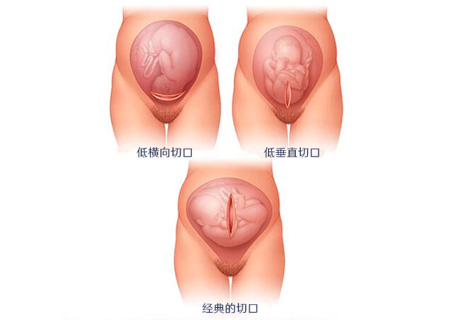 剖腹产刀口的3种类型