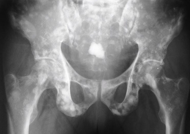 前列腺钙化X线图像