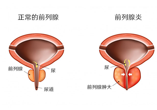 正常前列腺和前列腺炎对比图