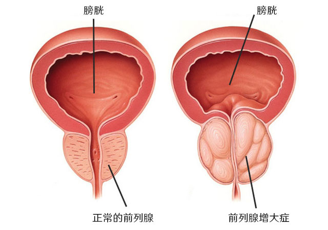 正常前列腺和前列腺增生症对比图