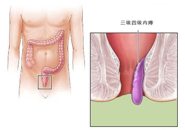 三级重度内痔疮图片