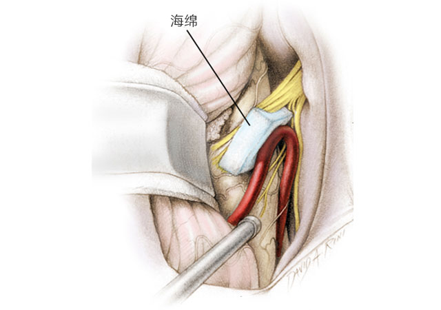 舌咽神经从脑干开始并在颈静脉孔处离开颅骨