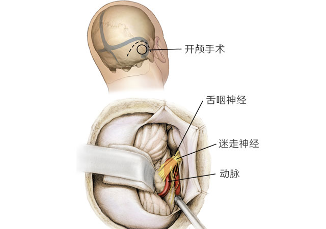 舌咽神经从脑干开始并在颈静脉孔处离开颅骨