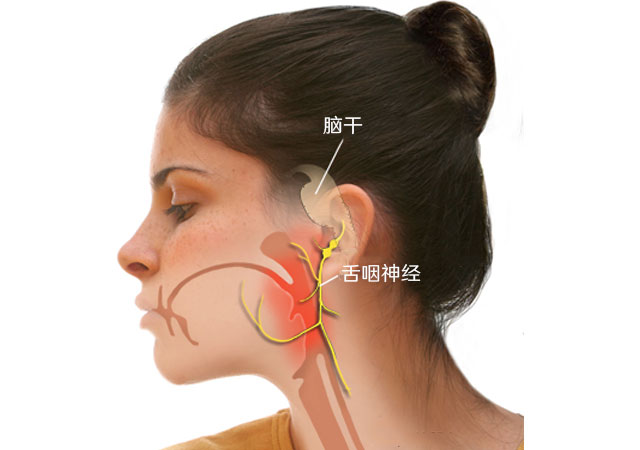 咽喉疼痛什么是舌咽神经痛的症状原因治疗方法药物图解