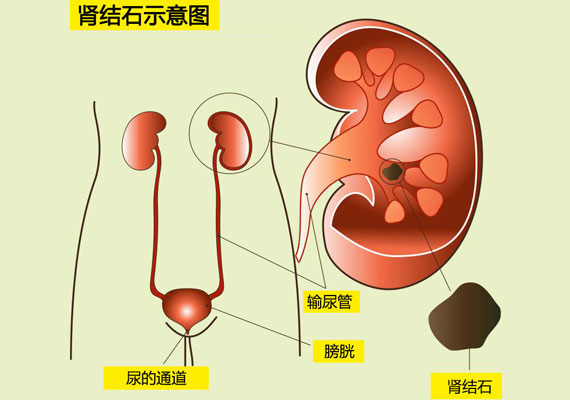 肾结石有什么症状示意图