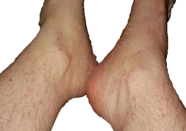 脚部长红点的原因白细胞破碎性血管炎