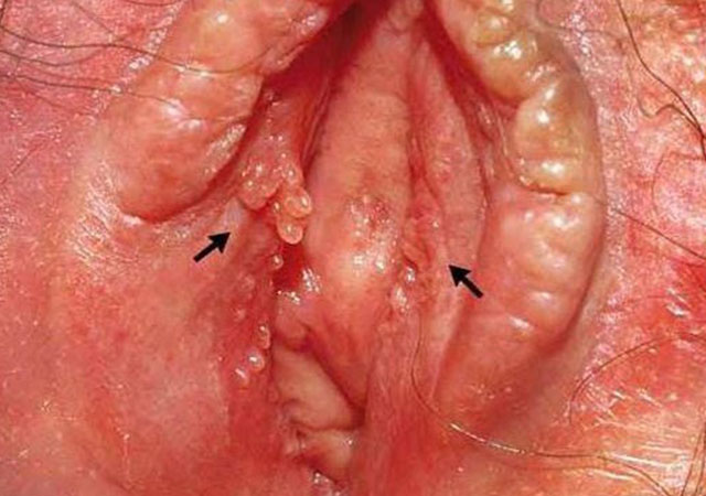 生殖器疱疹的危害短期和长期