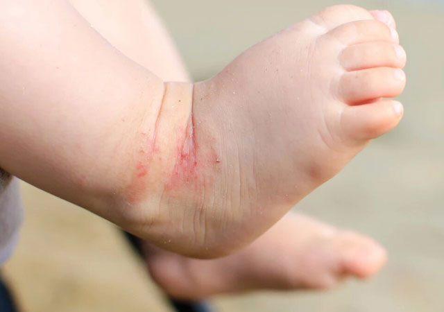 湿疹发生位置脚踝