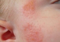 湿疹和热疹痱子的区别图片
