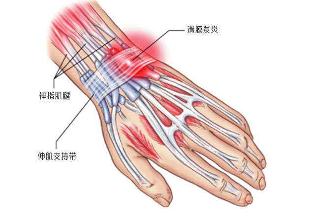 手腕腱鞘炎位置图片图片