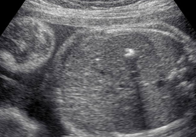 胎儿肝内钙化灶产前超声图像