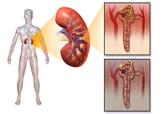糖尿病肾病图片
